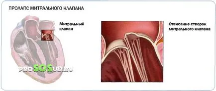Какво е пролапси