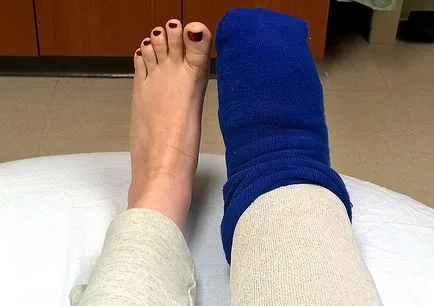 Какво е lymphostasis крака