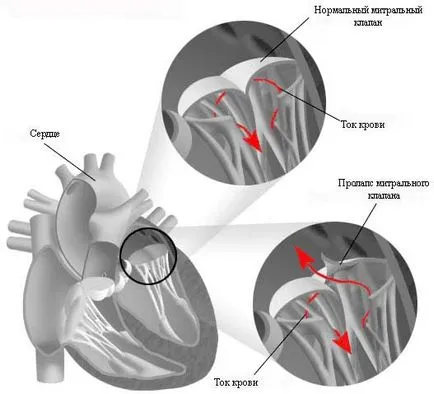 Какво е пролапси