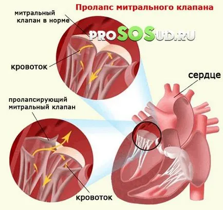 Какво е пролапси
