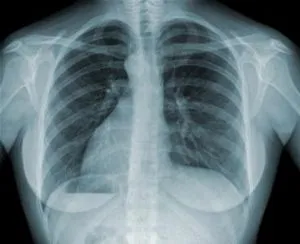 A zárt forma tuberkulózis, hogy ez A zárt forma tuberkulózis, hogy ez