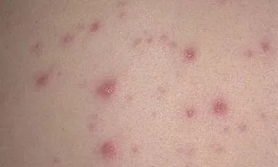 Варицелата е как изглежда