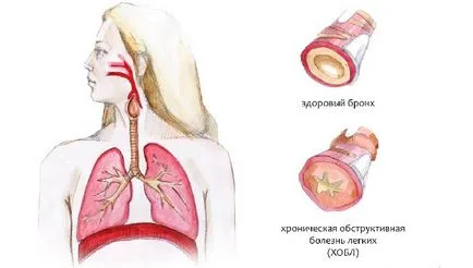 Хронична обструктивна лечение бронхит