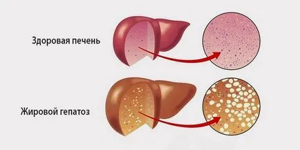 Какво е чернодробна стеатоза лечение
