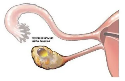 Лечението с антибиотици adneksita Лечението с антибиотици adneksita