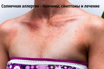 Алергия към слънцето, че тя