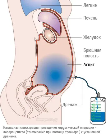 От което течността в корема
