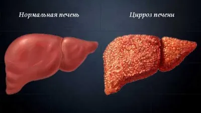 От което течността в корема