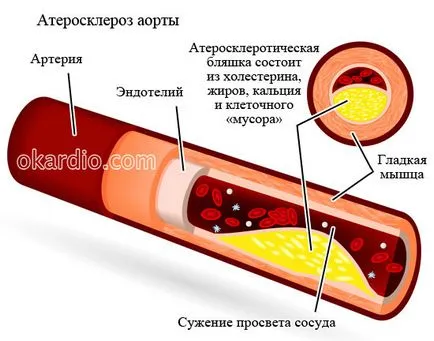 Атеросклерозата на аортата, че е