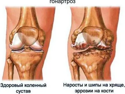 Болки в колената, отколкото лечение