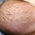 лечение Зайед на дете
