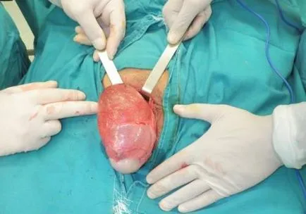 Всички ureaplasmosis лечение