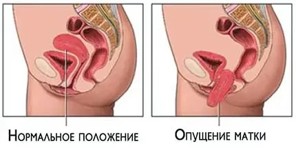 Какво се пада на матката Какво се пада на матката