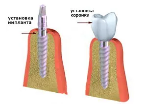зъби Inplontanty какво е