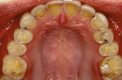 Булимия е това, което е