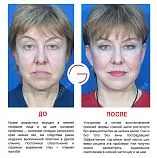 фейслифт какво