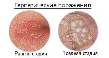 Херпес при мъжете и как