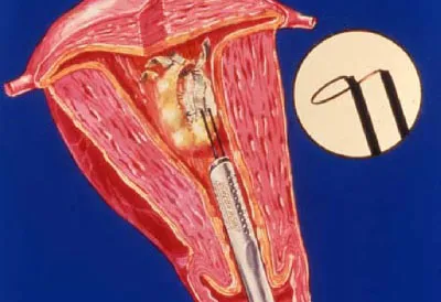 Hysteroresectoscopy какво е