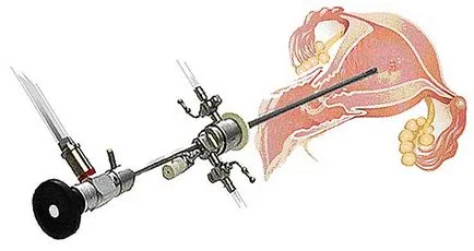 Hysteroresectoscopy какво е
