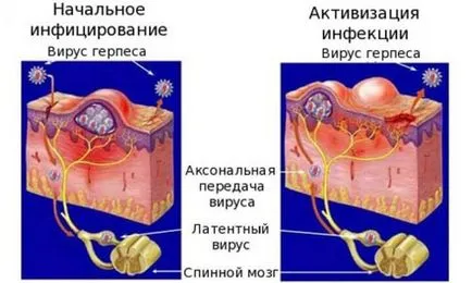 Херпес при мъжете и как