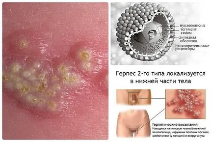Херпес при мъжете и как