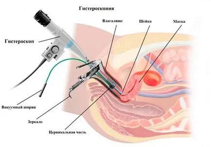 Hysteroresectoscopy какво е