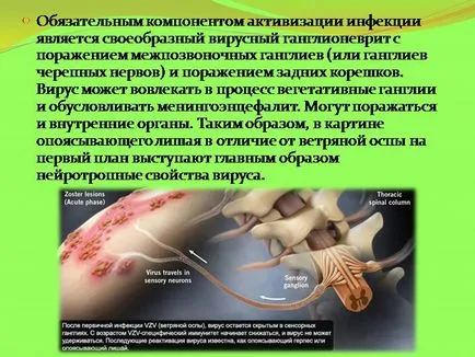 лечение и херпес зостер