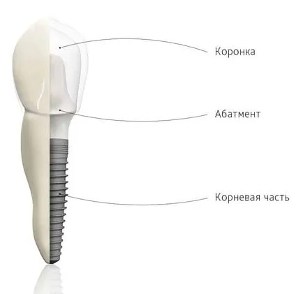 зъби Inplontanty какво е зъби Inplontanty какво е
