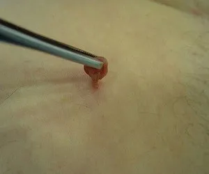 HPV férfiaknál