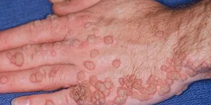 HPV férfiaknál HPV férfiaknál