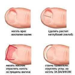 Как да се отървем от врастнали нокти