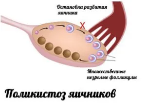 Какво е multifollikulyarny яйчниците