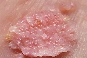 HPV férfiaknál HPV férfiaknál