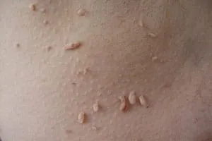 HPV férfiaknál HPV férfiaknál