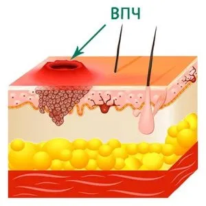 HPV férfiaknál HPV férfiaknál