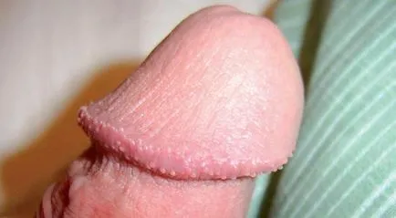 HPV férfiaknál HPV férfiaknál