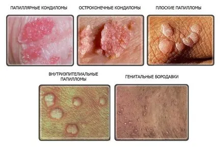 HPV férfiaknál