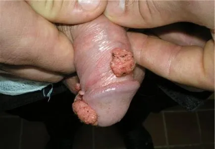 HPV férfiaknál HPV férfiaknál