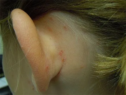 Mi a gyermek tetvek