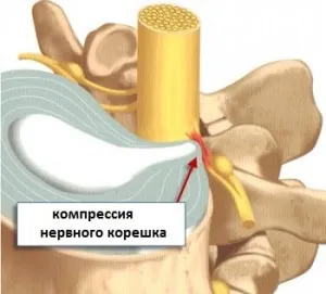 лечение електрофореза