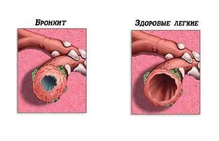 Суха кашлица, без да го треска