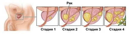 Как да се лекува гнойна инфекция при мъжете Как да се лекува гнойна инфекция при мъжете