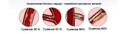 Как за лечение на исхемия