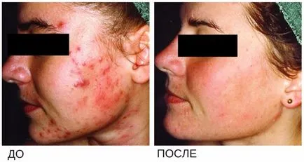 лазерно лечение на акне