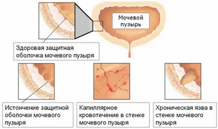 Как да се лекува гнойна инфекция при мъжете Как да се лекува гнойна инфекция при мъжете