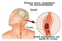 Церебрална циркулаторна лечение разстройство