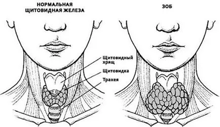 Лечение на народни средства за гуша