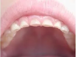 Защо skriplyu зъби през нощта