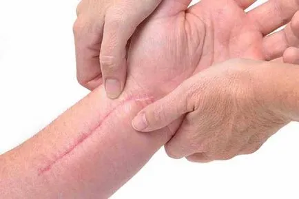 Как за лечение на пост-хирургични конци