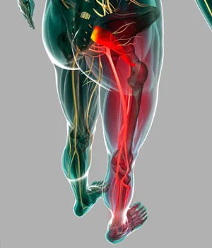 Beszűkített ülőideg kezelés